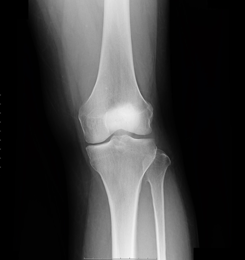 変形性膝関節 術前