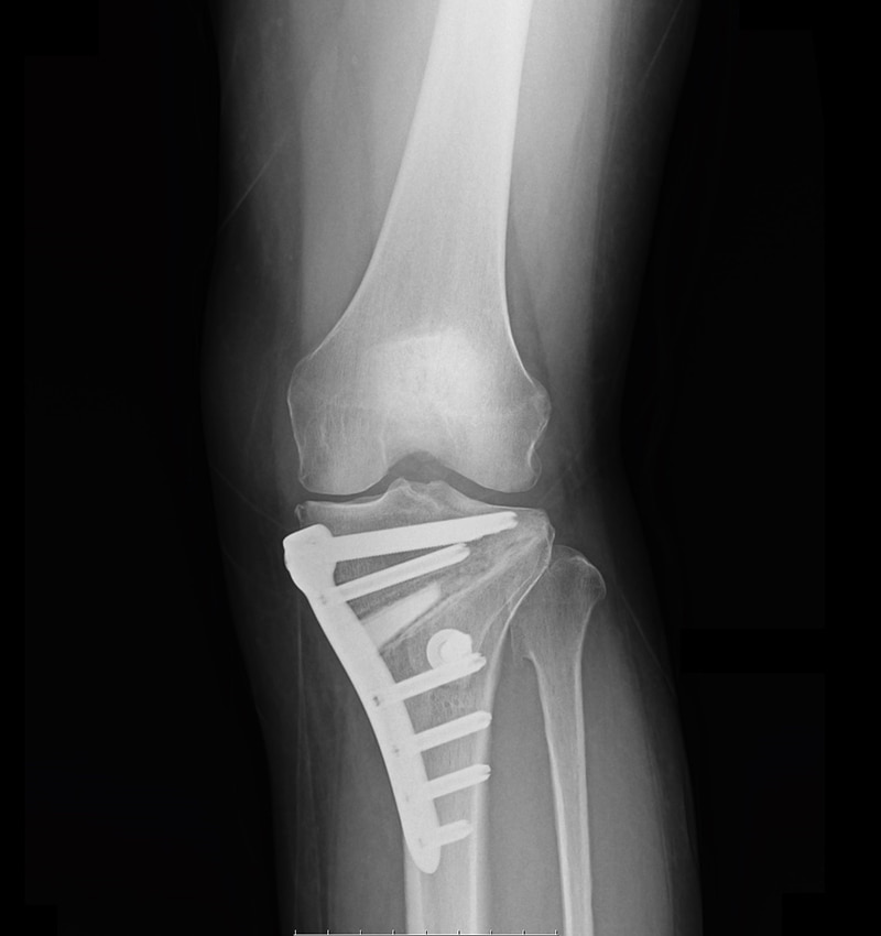 変形性膝関節 術後